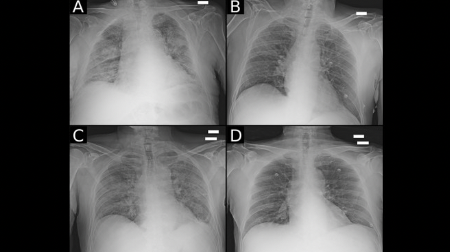 radiografia aws