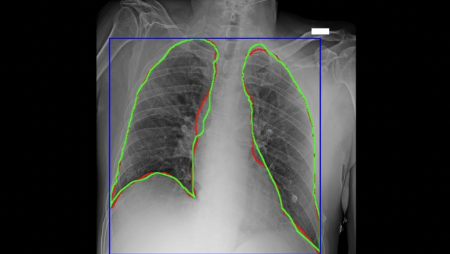 radiografia aws