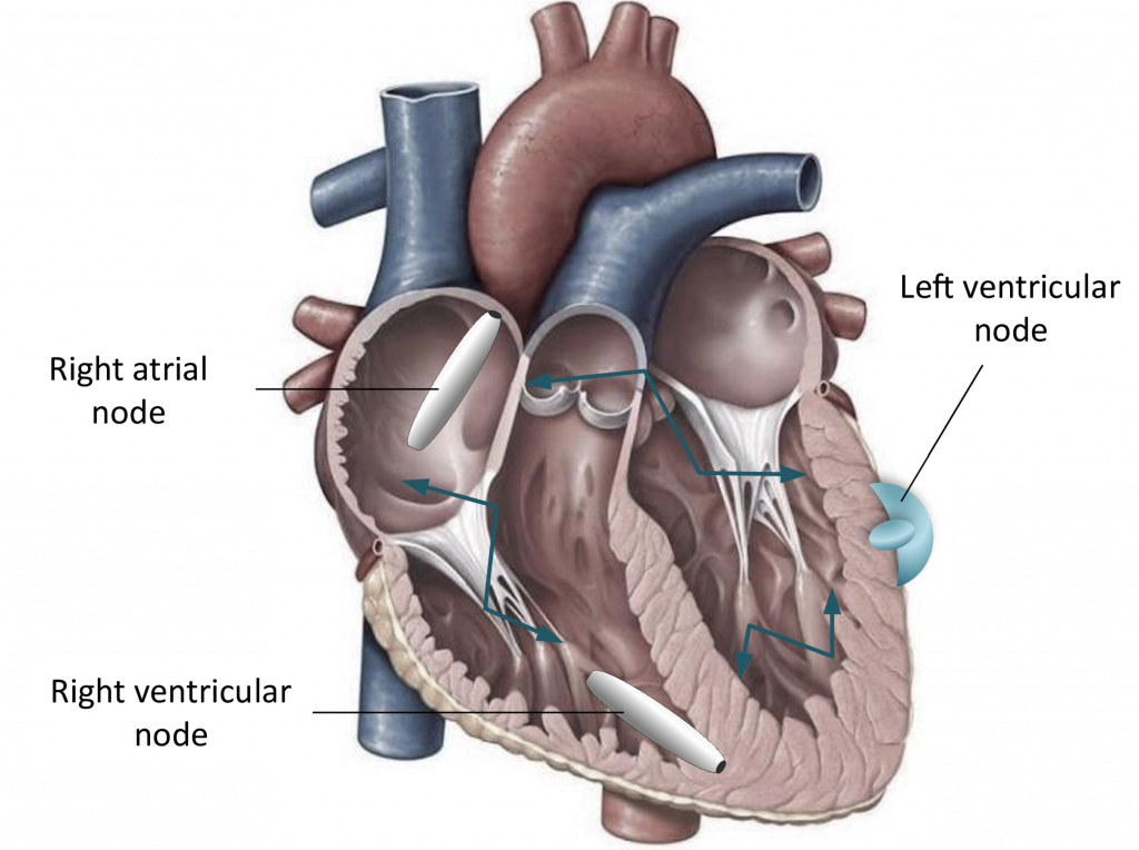 Sistema LCP multinodo con due capsule impiantate. L’immagine del cuore è stata modificata e riprodotta con il permesso di Pearson Education, Inc. di New York