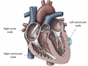 pacemaker cardiaci MicroPortSistema LCP multinodo con due capsule impiantate. L’immagine del cuore è stata modificata e riprodotta con il permesso di Pearson Education, Inc. di New York
