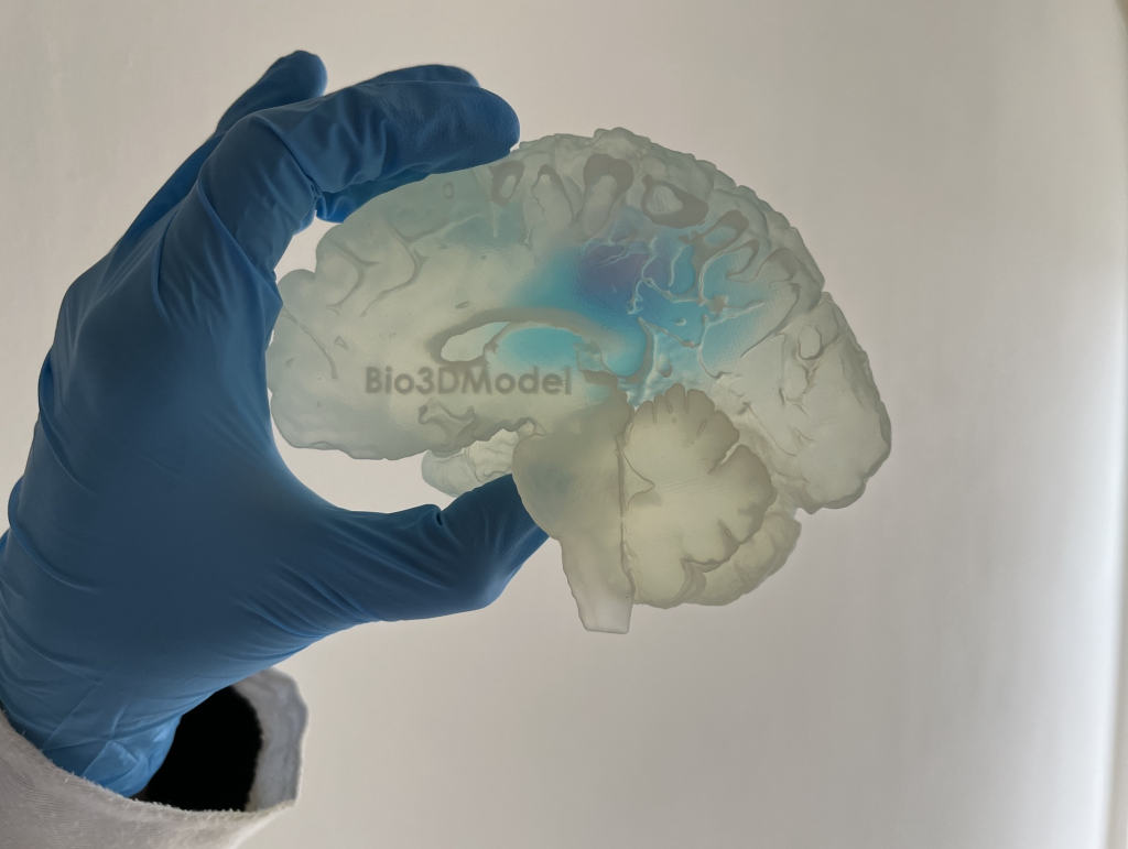 cervello con tumore-3D-SolidWorld