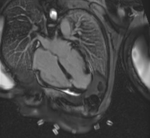 risonanza-magnetica-cardiaca