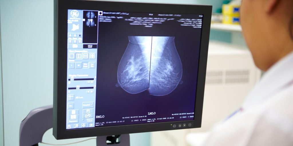 OPTIMAM image-cancro al seno