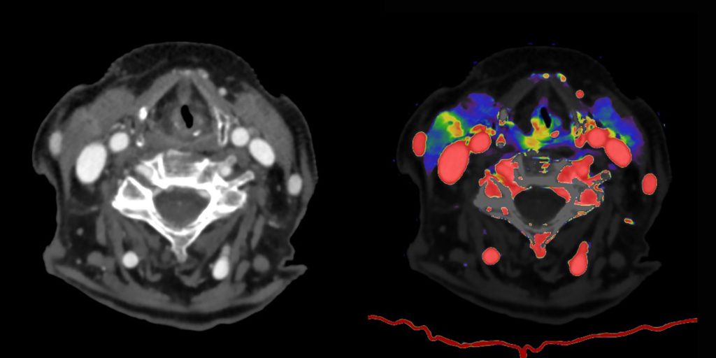 PHILIPS- Spectral CT