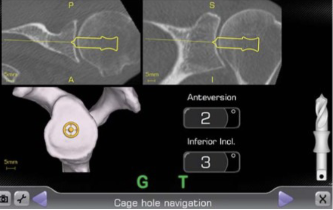 Protesi-Spalla-sacco