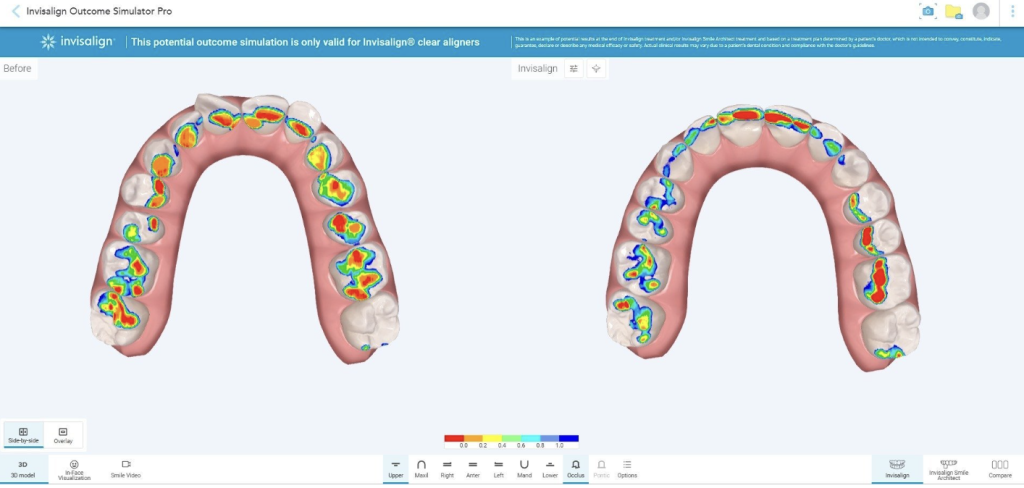 Align Technology: nuove soluzioni AI per l’odontoiatria digitale Align-odontoiatria